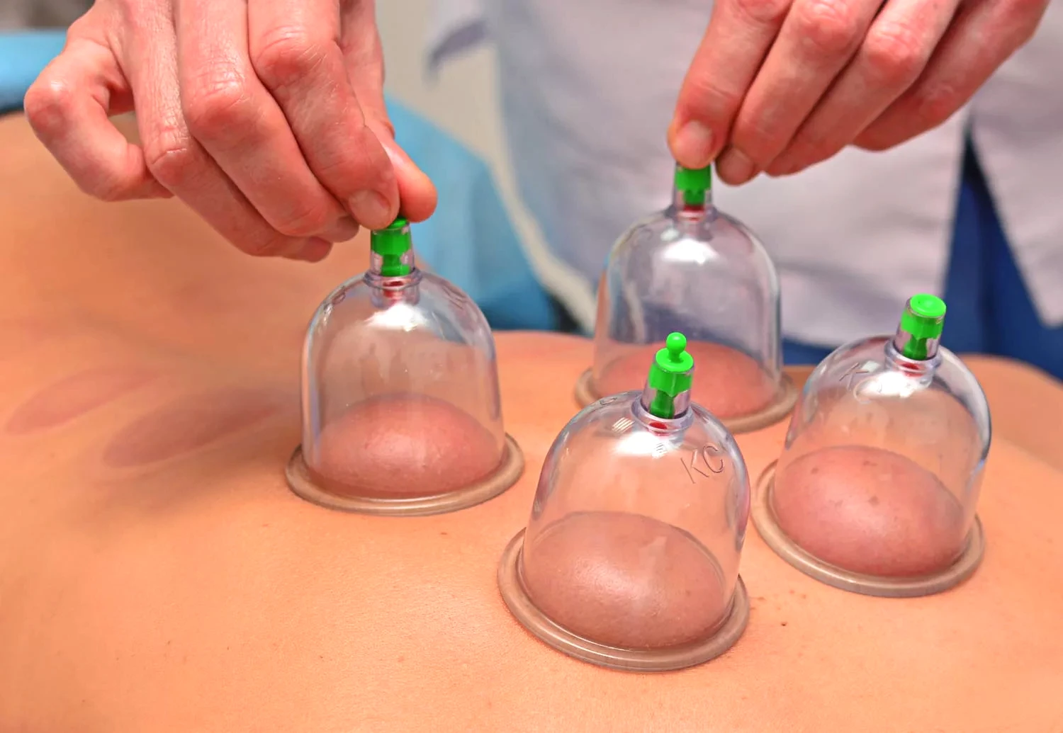 Close Up Of Physical Therapist's Hands Performing Cupping On Athelte's Back